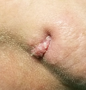 Chin lesion