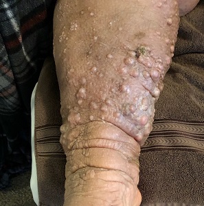 Leg nodules