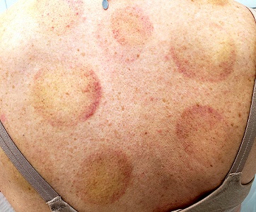 “Cupping” With Pain