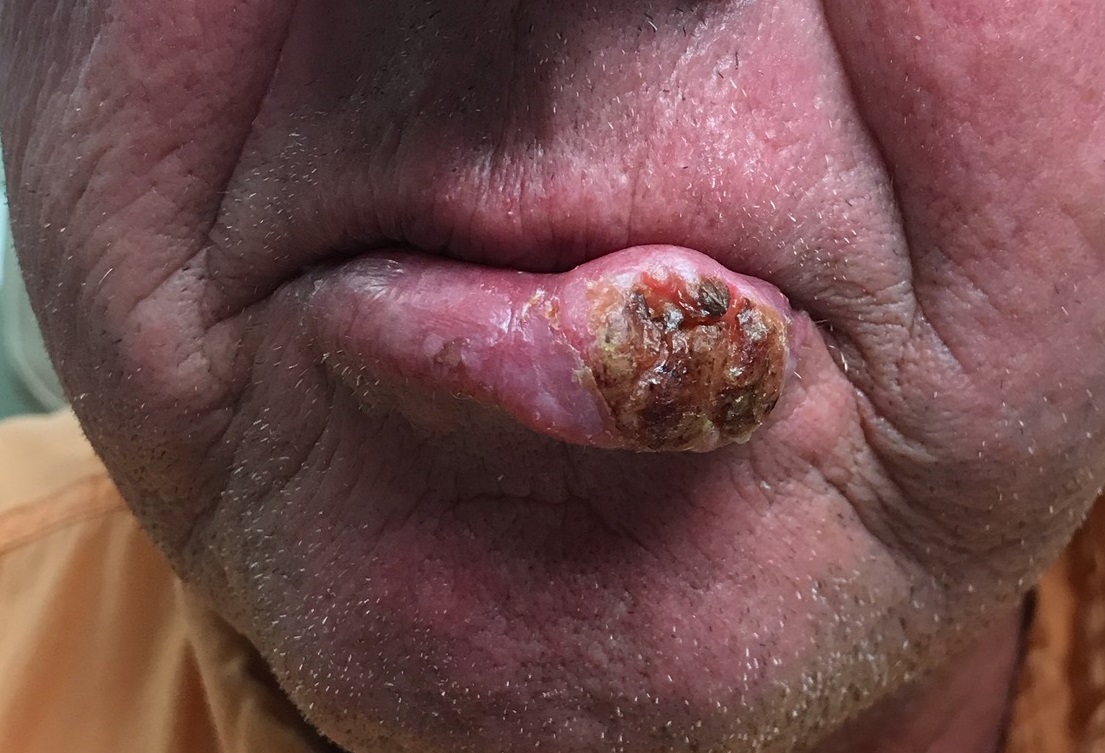 Lip lesion