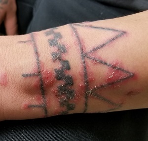 Wrist tattoo with rash