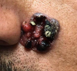 Face lesion