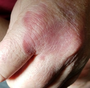 Hand rash