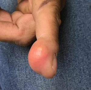 Finger lesion