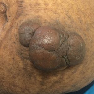 Cutaneous Insulin-Derived Amyloidosis Presenting as Hyperkeratotic Nodules