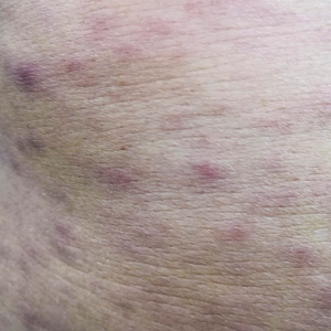 scrub typhus