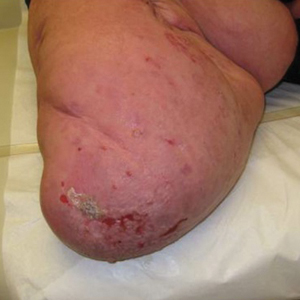 Stump Pemphigoid