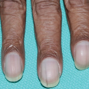 Unilateral Nail Clubbing in a Hemiparetic Patient 