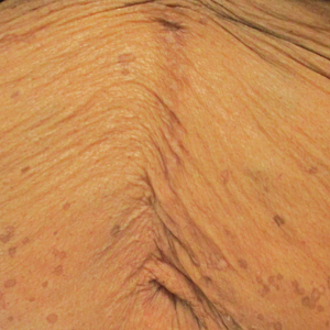 Eruptive Annular Papules on the Trunk of an Organ Transplant Recipient