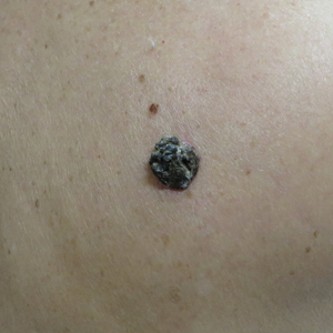 Dark Brown Hyperkeratotic Nodule on the Back