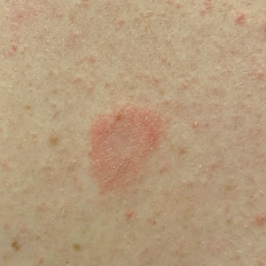 Classic pityriasis rosea “herald patch” on the left side of the upper back