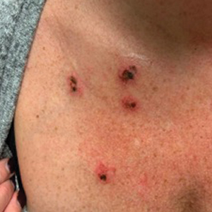 Superficial necrotic lesions on the right side of the upper chest