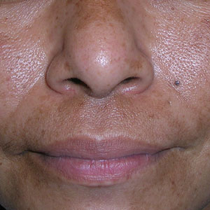 Melasma