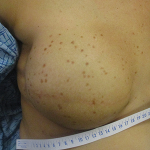 Diffusely scattered macules following radiation therapy 