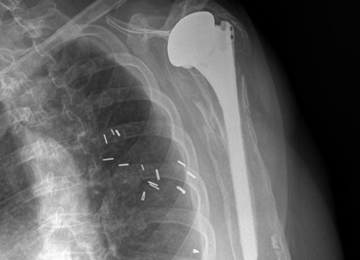 Humeral Bone Loss in Revision Shoulder Arthroplasty