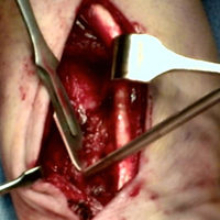 Dual Radial Styloid and Volar Plating for Unstable Fractures of the Distal Radius