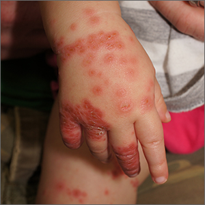 Widespread rash in toddler