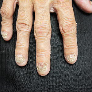 Nail dystrophy 