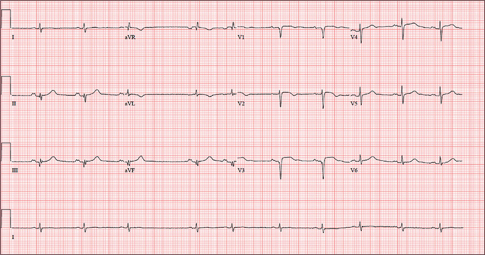 Man Shovels Path to Angina image