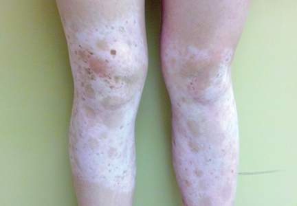 Multiple asymptomatic light-colored patches on the bilateral arms and legs of an adolescent female. 