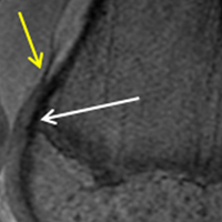 Special Considerations for Pediatric Patellar Instability