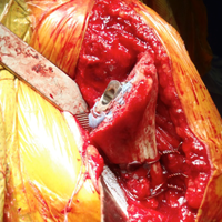 Treating Humeral Bone Loss in Shoulder Arthroplasty: Modular Humeral Components or Allografts