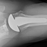 Managing Glenoid Bone Deficiency—The Augment Experience in Anatomic and Reverse Shoulder Arthroplasty