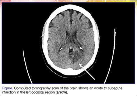 Atypical Acute Myocardial Infarction and Concomitant Acute Cerebral ...