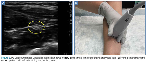 Emergency Ultrasound: Ultrasound-Guided Ulnar, Median, and Radial Nerve ...