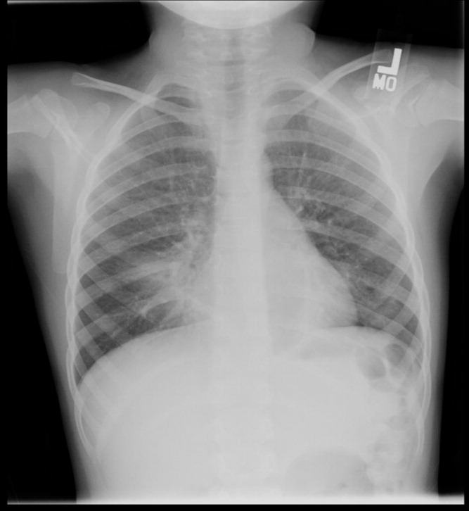 walking pneumonia chest x ray findings