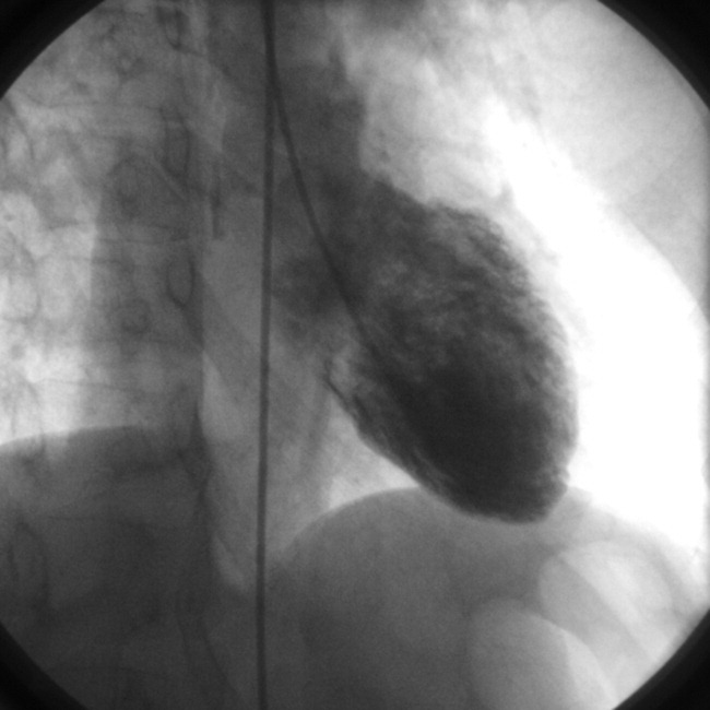 Takotsubo Cardiomyopathy Journal Of Hospital Medicine