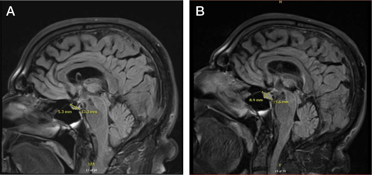 0526FED-AVAHO-Hypophysitis_F1