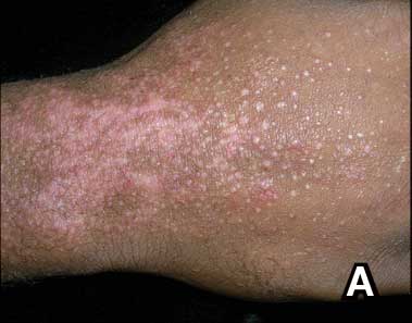 0626FED-eCutis-Atopic-Derm-F1