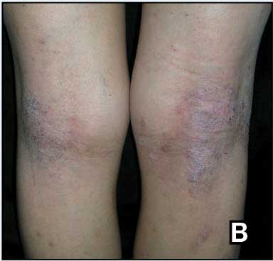 0626FED-eCutis-Atopic-Derm-F2