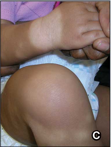0626FED-eCutis-Atopic-Derm-F3