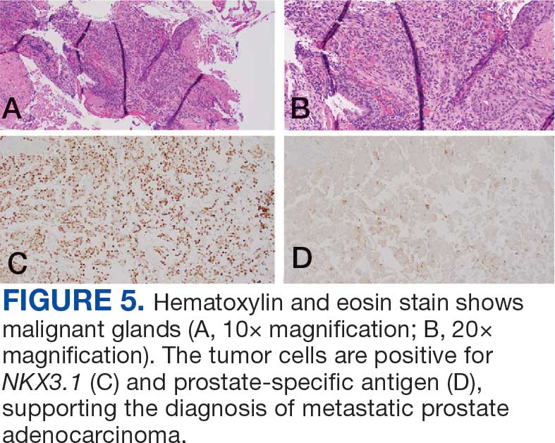 0825FED-AVAHO-Prostate-F5