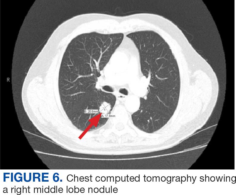 0825FED-AVAHO-Prostate-F6