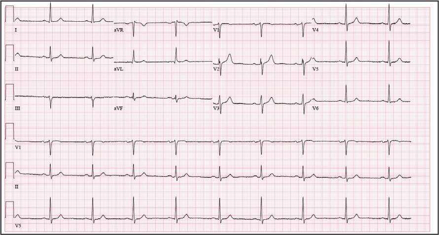 APPENDIX 2. Electrocardiogram showing a finely static background consistent with the electric hospital stretcher artifact. Key findings include sinus bradycardia, wide P waves (> 80 ms) with notching in lead II, sinusoidal P waves in lead V1, an R transition in lead V2, an RR’ pattern in lead V2, and flat ST segments in lead III.