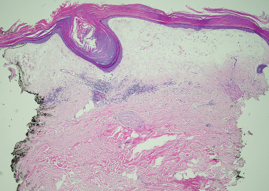 Histopathology revealed hyperkeratosis, follicular plugging, papillary dermal pallor, and adjacent lymphocytic inflammation, confirming the clinical diagnosis of lichen sclerosus