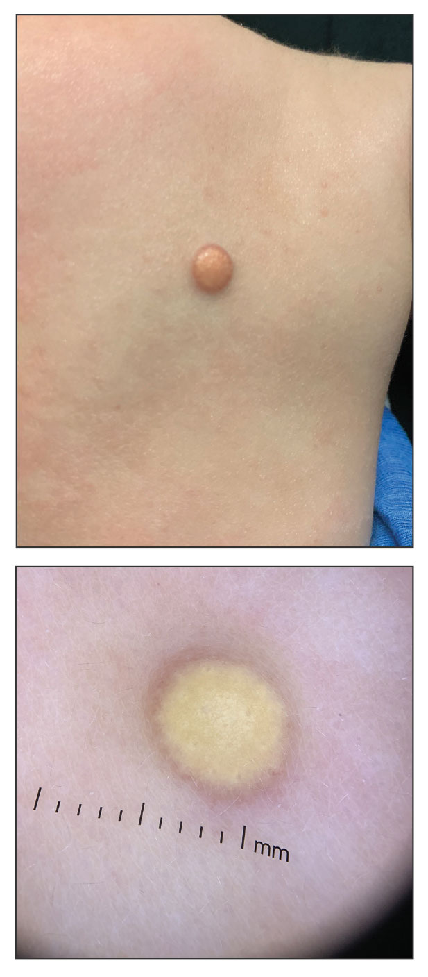 Solitary Yellow Papule on the Upper Back in an Infant