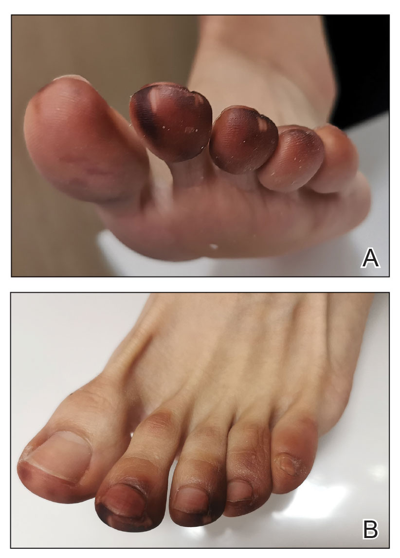 FIGURE 1. A and B, Following contact with a millipede, the patient developed purplish-red discoloration on the foot that mimicked ischemia. The discoloration on the second and third toes was particularly vivid. 