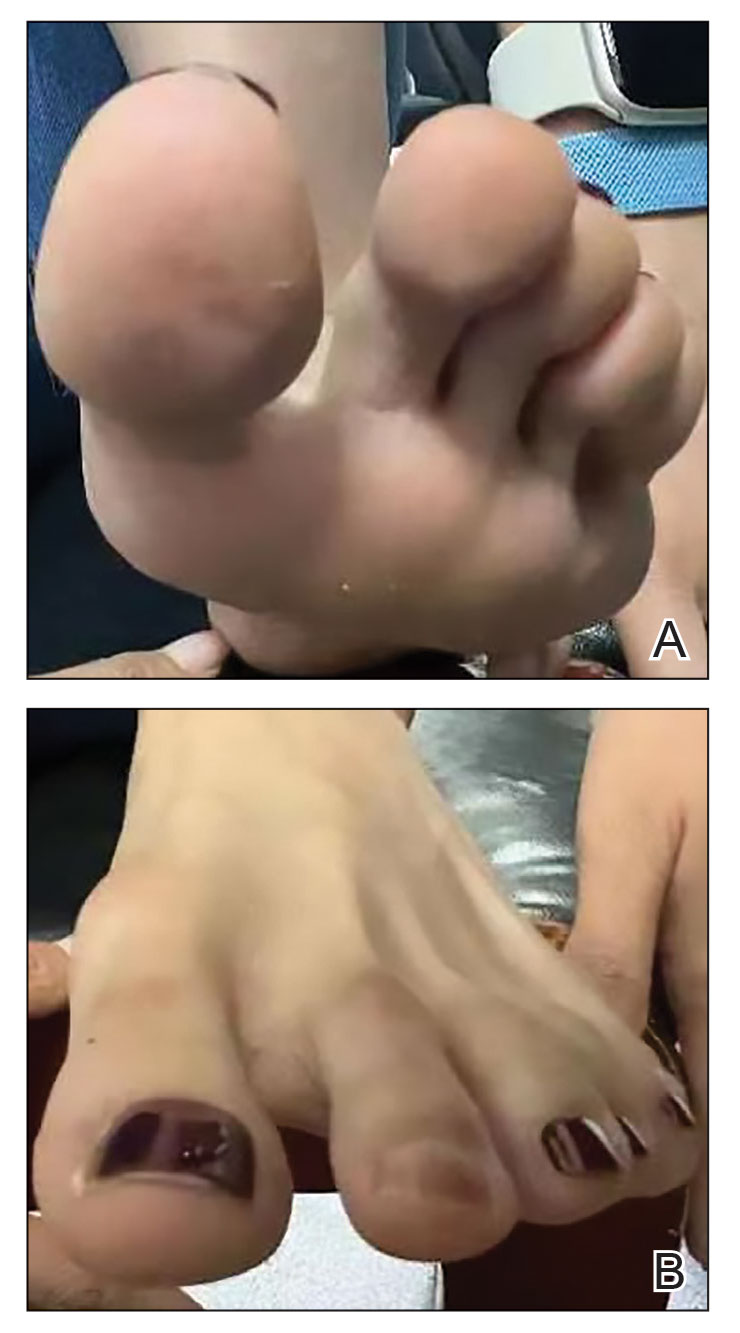 FIGURE 4. A and B, One month after the patient sought treatment, the color of the toes returned to normal.
