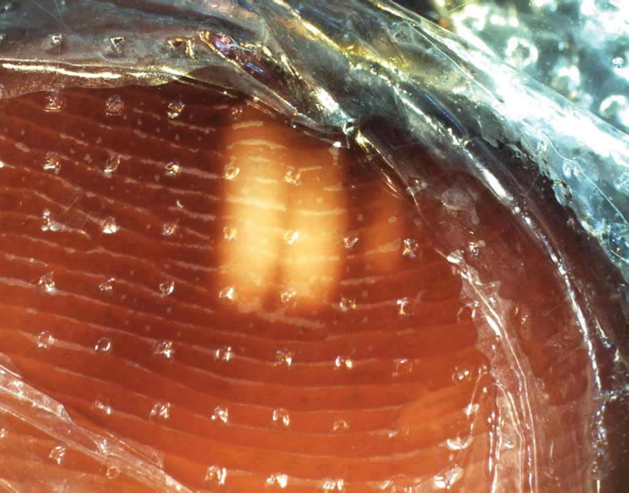 FIGURE 3. Dermoscopy revealed multiple black-brown patches on the patient’s toes (original magnification ×20). The 3 white lines in the center of the image represent normal skin.