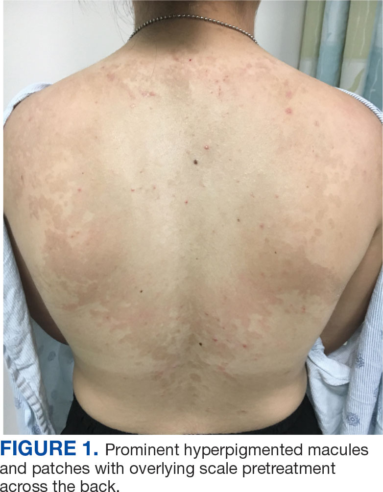 Pityriasis Versicolor In A 42yearold Female Patient The