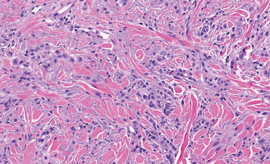 Hill-dermpath-1
