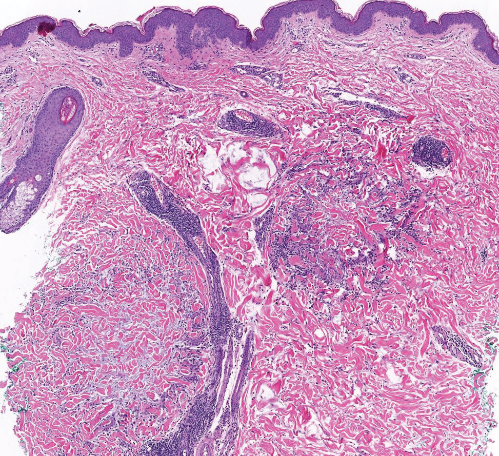 Hill-dermpath-3