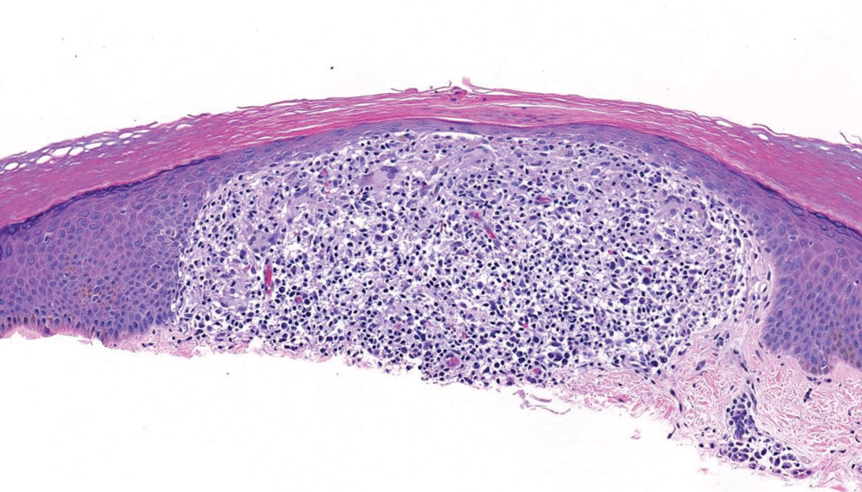 Hill-dermpath-4