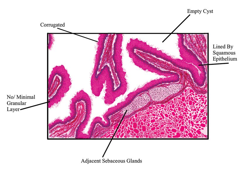 Steatocystomas Update On Clinical Manifestations Diagnosis And 