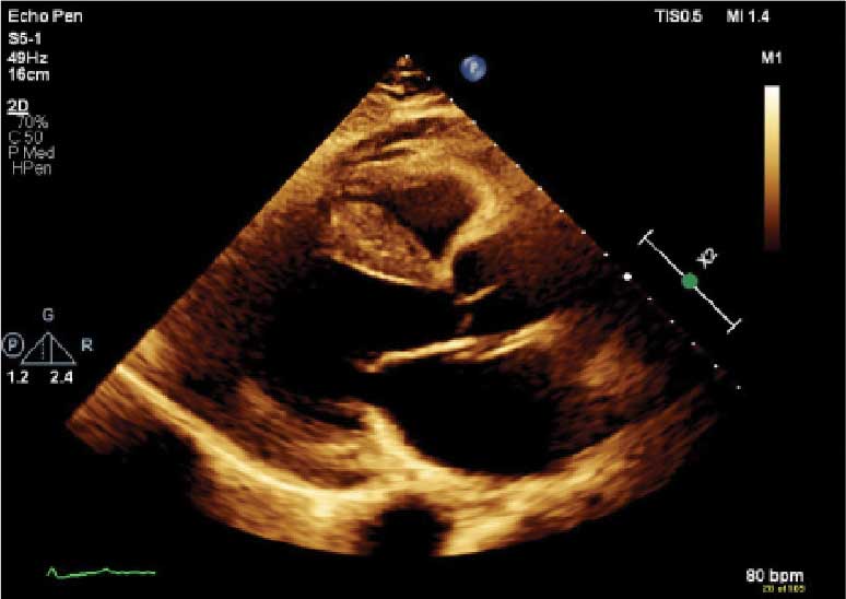 eAmyloidosis-eF1