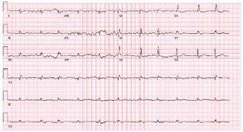 eAmyloidosis-eF2